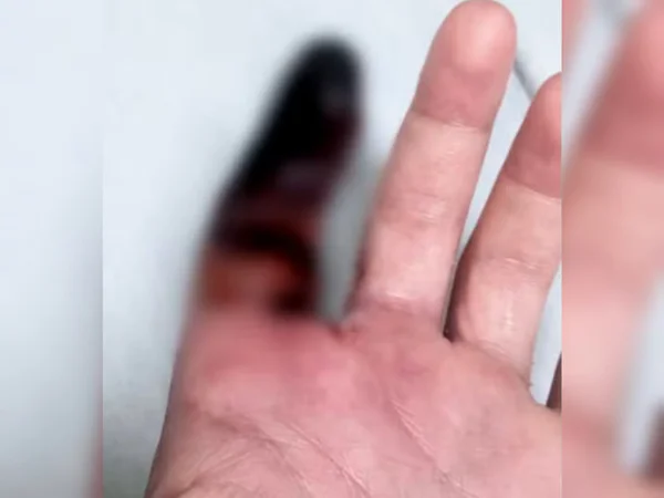 Imagem de mão com dedo indicador necrosado - Metrópoles