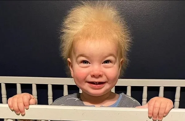 Mini-Einstein: bebê tem síndrome rara que deixa seu cabelo arrepiado