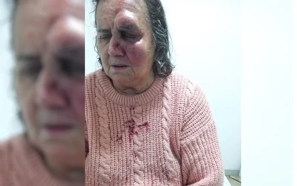 Idosa que teve nariz quebrado após ataque de cão: “Estou com medo”