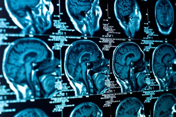 Neuromarketing, a ciência tenta entender o cérebro do consumidor