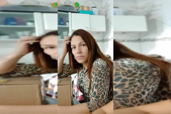 Mulher com rosto queimado por ácido jogado pelo ex-marido será operada