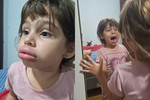 Vídeo: menina incha lábios com tampinha e se desespera com resultado