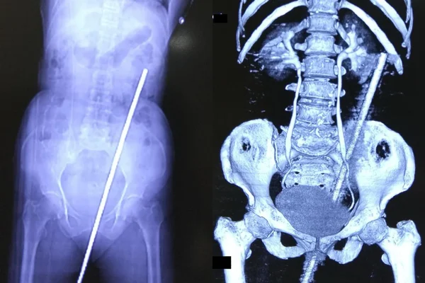 Imagem mostra o raio x de uma mulher que ficou empalada em ferro de 60 cm após cair no chão do quintal