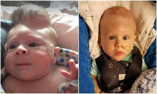 Bebê com cérebro fora do crânio sobrevive a cirurgia reparatória