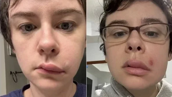 Foto colorida de uma jovem que precisou ir para o hospital após estourar uma espinha - Metrópoles