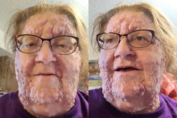 na foto, uma montagem de uma mulher mais velha com deformidade no rosto