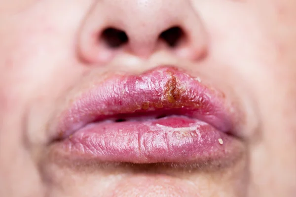 Feche a foto com profundidade de campo rasa de uma grande infecção por herpes simplex nos lábios.