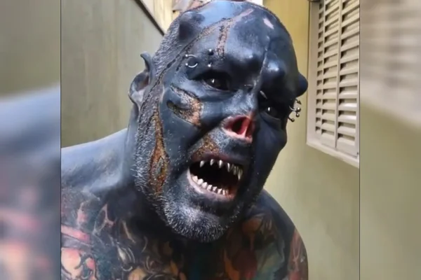 Caveira que tirou o nariz e trocou os dentes decidiu queimar o rosto para modificar o corpo - Metrópoles