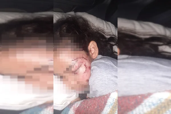 Menina deitada com pontos no rosto