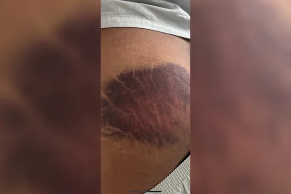 Imagem colorida de um homem com o corpo machucado - Metrópoles