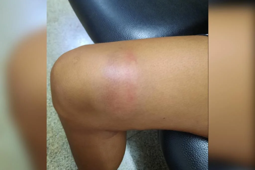 Segundo relatos da vítima, o objeto teria se partido ao meio durante as agressões Segundo relatos da vítima, o objeto teria se partido ao meio durante as agressões