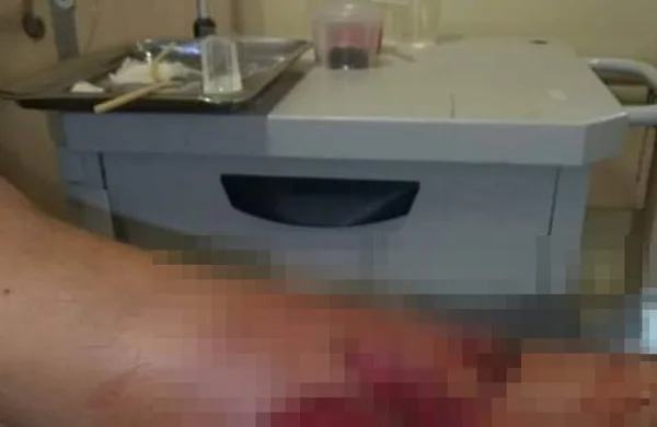 DF: cachorro avança em adolescente e causa ferimentos graves