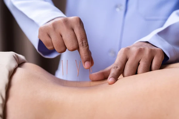 Acupuntura