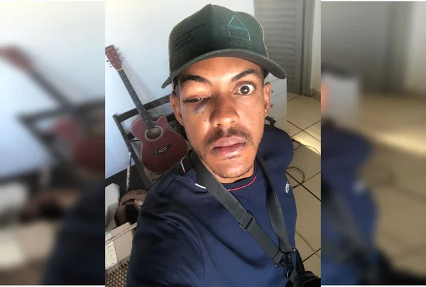 Jovem é agredido e fratura rosto em briga, por “atrapalhar” estacionamento no DF