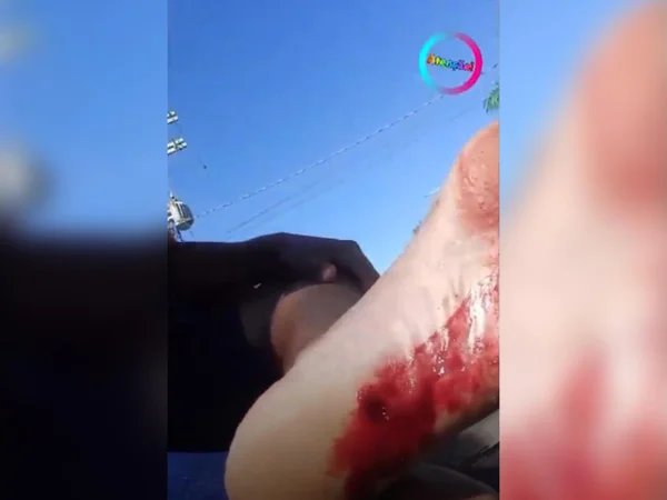 foto colorida de pé ferido de banhista em prainha de Pereira Barreto, interior de SP, após ataque de piranha - Metrópoles
