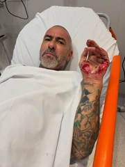 Chef Henrique Fogaça mostra lesões de acidente de moto que o afastou do MasterChef