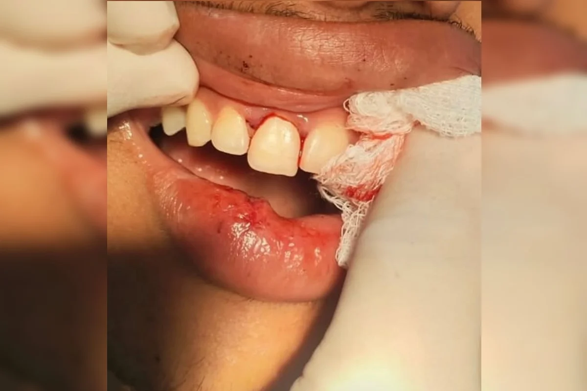 Dente quebrado e pisão na cabeça: trio agride e ameaça adolescentes 3 Dente quebrado