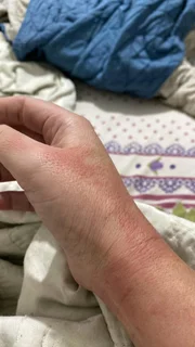 A panela estourou quando Rafaela Rocha, 35 anos, manuseou o objeto A panela estourou quando Rafaela Rocha, 35 anos, manuseou o objeto