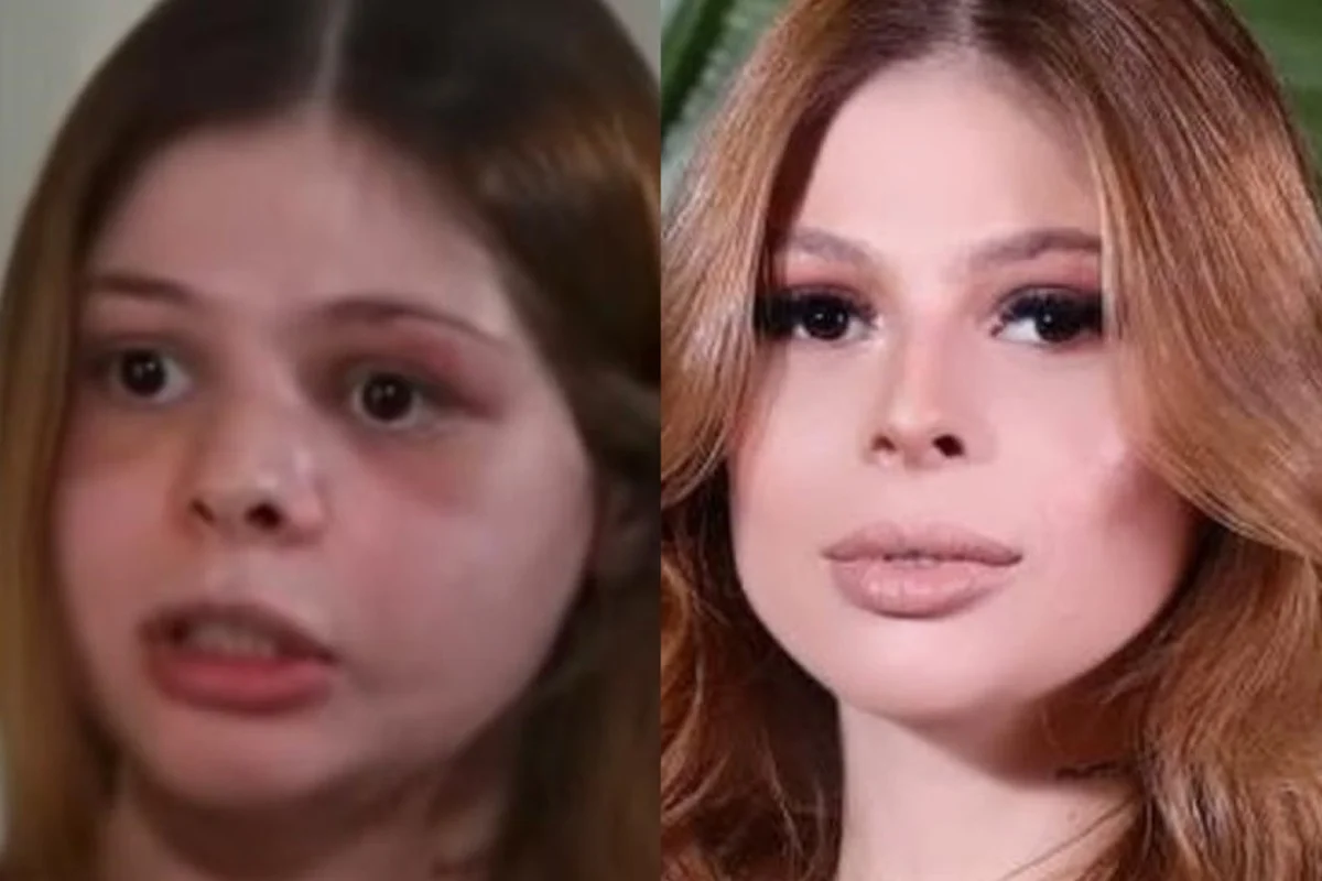 Samira Khouri foi atacada pelo namorado, sofreu fratura no crânio, múltiplas lesões na face e perdeu 50% da visão de um dos olhos Samira Khouri foi atacada pelo namorado, sofreu fratura no crânio, múltiplas lesões na face e perdeu 50% da visão de um dos olhos