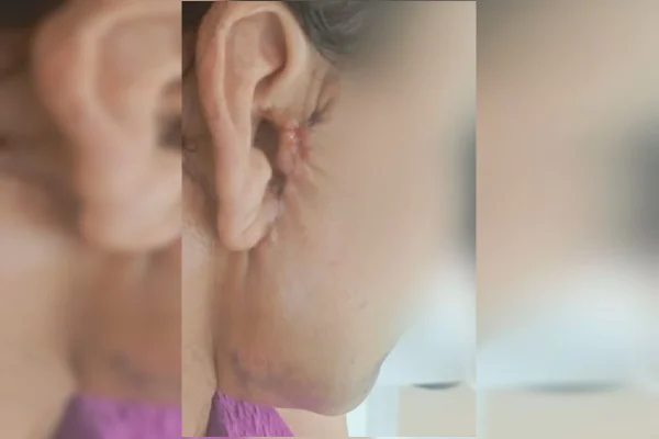 Foto mostra orelha de cliente deformada por dentista em procedimento em GO