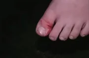 Pé do menino após o acidente