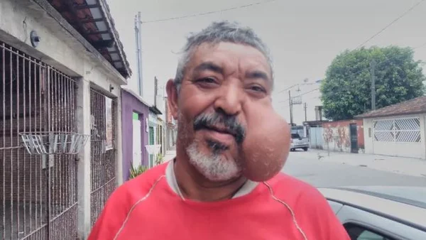homem com cisto gigante no rosto Metrópoles
