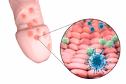 <b>Herpes genital -</b> Altamente contagiosa, a herpes genital é causada pelo vírus Herpes simplex (HSV). As pessoas infectadas podem desenvolver pequenas bolinhas vermelhas muito próximas umas das outras na pele das coxas, anus e órgãos genitais. Essas bolinhas contêm um líquido altamente viral de cor amarelada que causa coceira. Além disso, a doença pode se manifestar com febre, dor ao urinar e, no caso de mulheres, corrimento