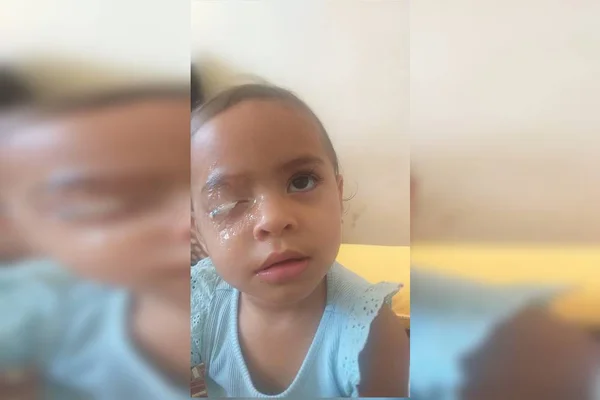 Menina passará por cirurgia após aplicar Super Bonder no olho
