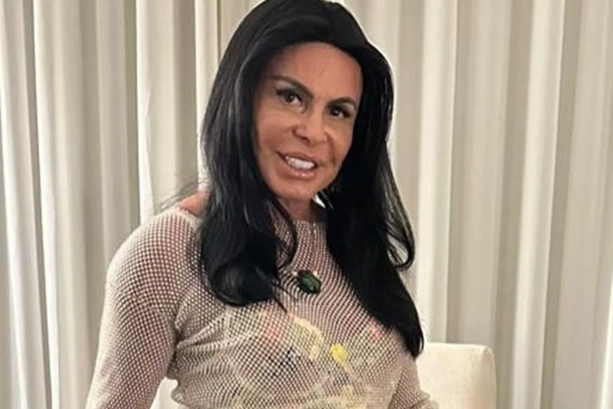 Transplante de Gretchen por alopecia: médicos explicam queda de cabelo Transplante de Gretchen por alopecia: médicos explicam queda de cabelo