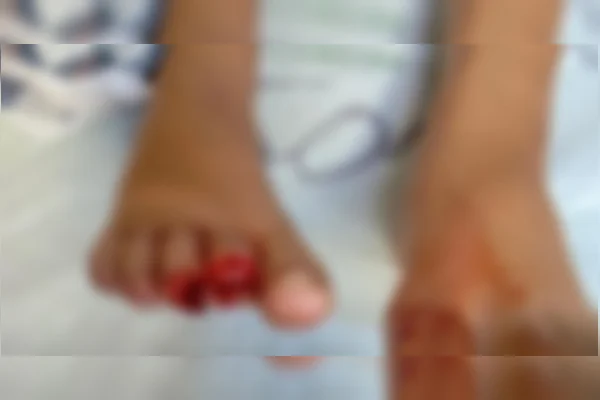 Criança de 9 anos tem parte dos dedos arrancada em ataque de piranhas
