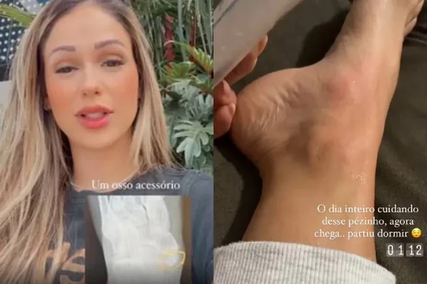 Bailarina descobre osso “extra” após torcer o pé em ensaio do Domingão