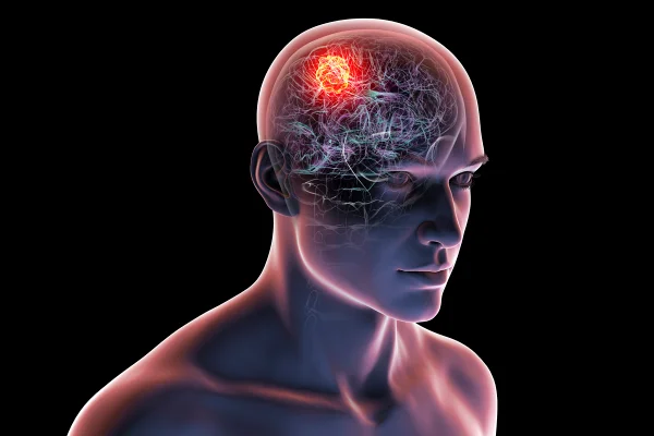 Ilustração colorida de silhueta humana com caroço em envidência no cérebro / glioblastoma - Metrópoles.