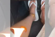 Essa condição é uma reação alérgica grave às proteínas da saliva do mosquito, causando inflamação intensa, inchaço, dor e bolhas