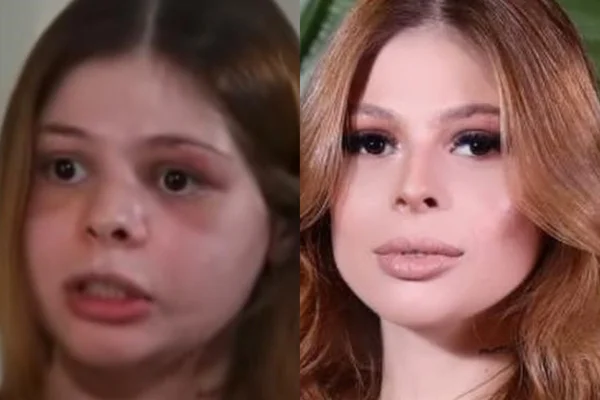 Samira Khouri foi atacada pelo namorado, sofreu fratura no crânio, múltiplas lesões na face e perdeu 50% da visão de um dos olhos - Metrópoles