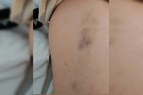 Veja fotos de lesões em mulher espancada por empresário em elevador