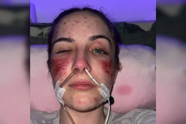 Jovem doença misteriosa sofre queimaduras quando ri Beth Tsangarides jovem que chora lágrimas ácidas 3