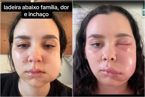 Imagem colorida: jovem com o rosto inchado após cirurgia de remoção do siso - Metrópoles