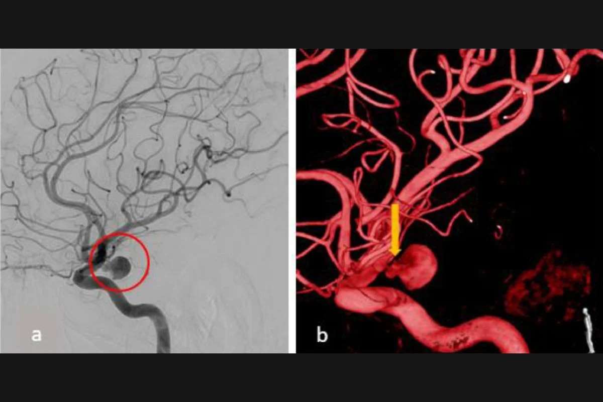 Uma angiografia tridimensional mostrou que o aneurisma tinha uma forma irregular e pequenas bolsas que indicavam onde havia se rompido Uma angiografia tridimensional mostrou que o aneurisma tinha uma forma irregular e pequenas bolsas que indicavam onde havia se rompido