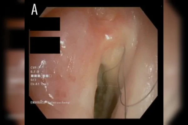 Foto mostra exame de endoscopia da garganta de homem que desenvolveu pelos na garganta por culpa do hábito de fumar - Metrópoles
