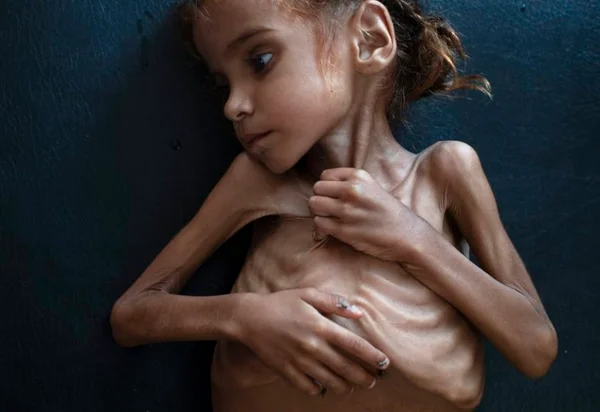 Fome extrema atinge mais de 113 milhões de pessoas no mundo
