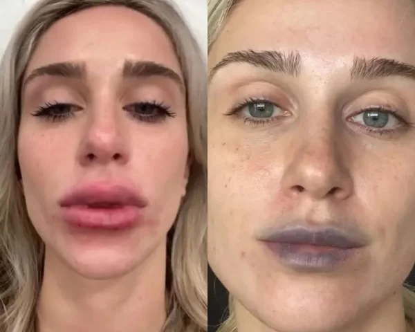 Koko Beaute e procedimento labial