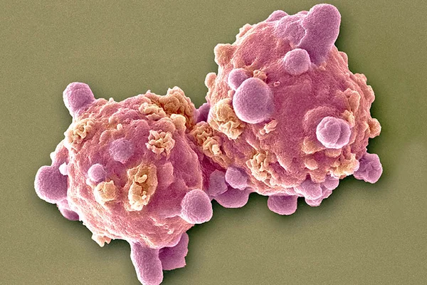 Saiba mais sobre a leucemia, um tipo de câncer na medula óssea