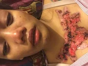 Garota relata momentos de dor ao remover tatuagem com método polêmico - imagem 5 Garota relata momentos de dor ao remover tatuagem com método polêmico - imagem 5