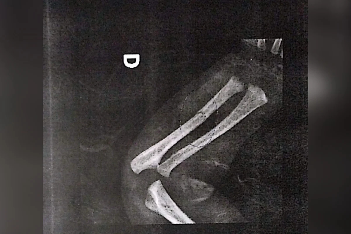 Bebê é levada ao hospital com ossos quebrados e pais são presos - imagem 1 Bebê é levada ao hospital com ossos quebrados e pais são presos - imagem 1
