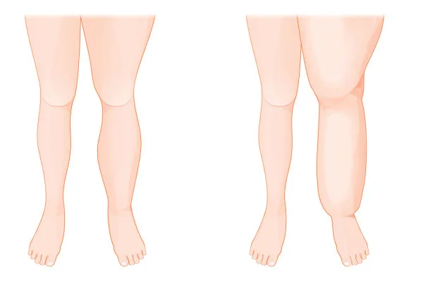 Ilustração de duas pernas de pessoas com lipedema - Metrópoles
