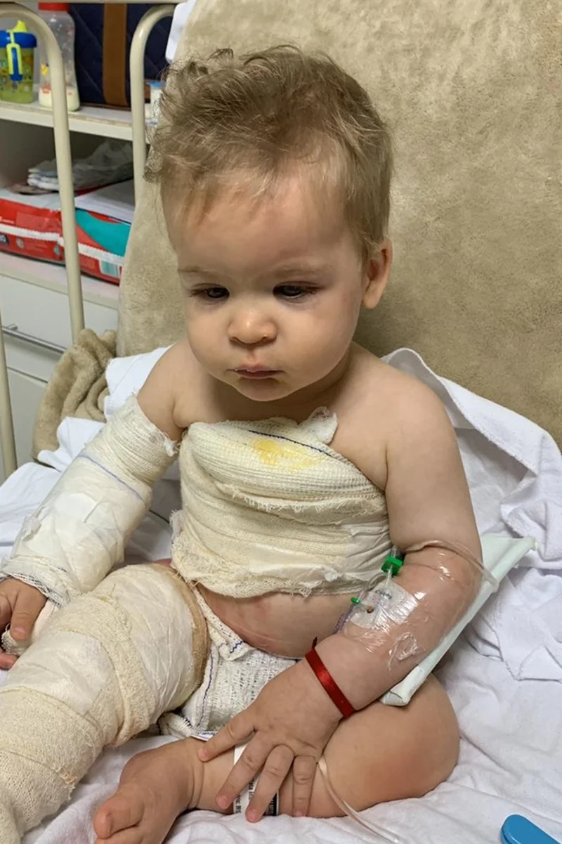 Jorge ficou internado na UTI após sofrer queimaduras por líquido quente Jorge ficou internado na UTI após sofrer queimaduras por líquido quente