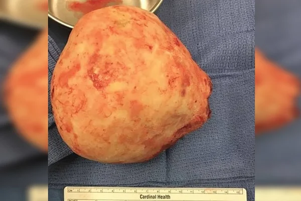 Médicos encontram pedra do tamanho de ovo de avestruz em paciente