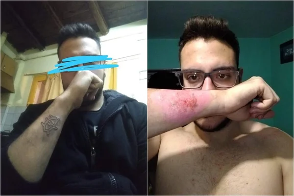 Jovem faz tatuagem, se arrepende e a remove com ralador