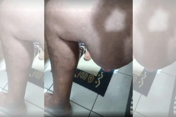 Imagem mostra calombo grande na perna de um homem - Metrópoles