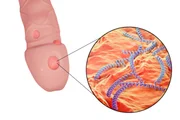 <b>Sífilis -</b> A sífilis é uma infecção bacteriana geralmente transmitida pelo contato sexual ou pelo contato com sangue infectado. Os primeiros sintomas surgem no intervalo de três a 12 semanas após o contágio, provocando feridas e manchas vermelhas nas mãos e pés que não sangram e nem causam dor. A sífilis pode provocar cegueira, paralisia e problemas cardíacos